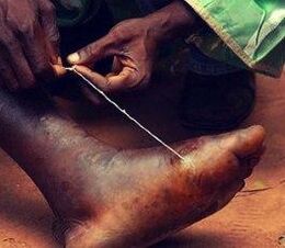 Parasite sur le pied d'une personne
