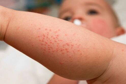 Allergie chez un enfant comme symptôme de la présence de vers.