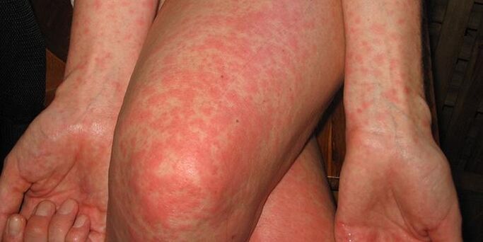 symptômes de parasites dans le corps